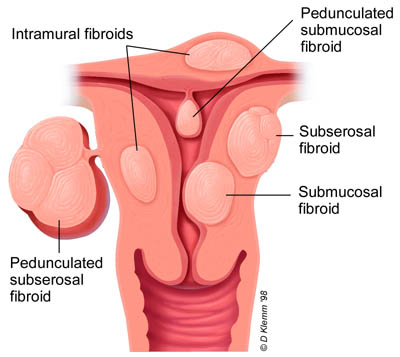 fibroid5